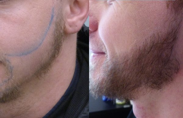 J'ai choisit la technique FUE New Dense car elle est invisible, ne laisse pas de cicatrice et permettait de créer ma barbe en une fois.