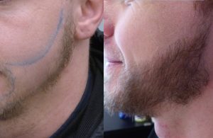 Greffe de barbe chez un jeune homme